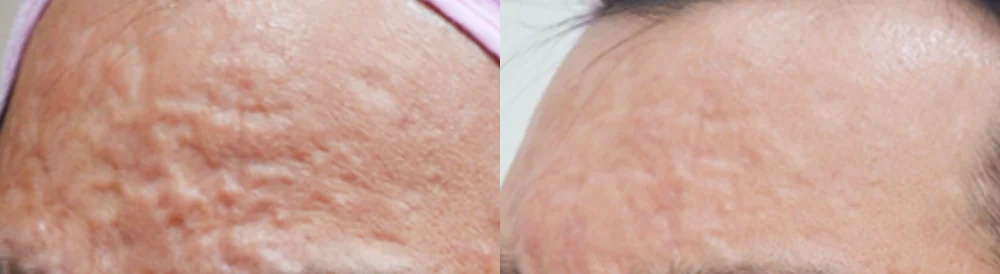 수두·마마·구순열 흉터 시술 전후 사진 14 · 보니따의원