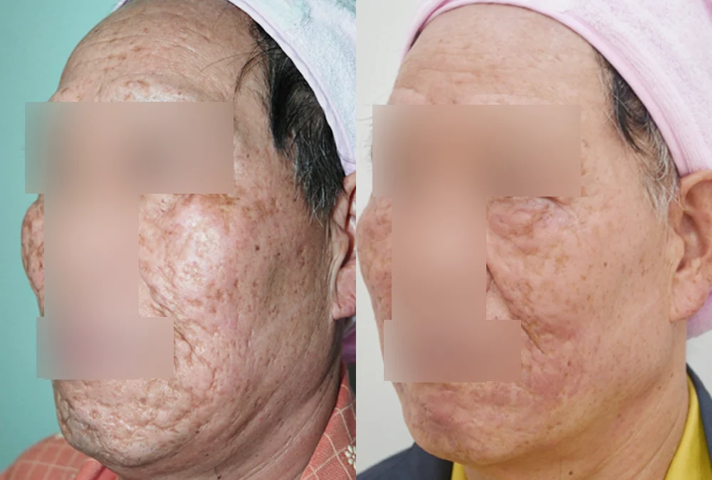 수두·마마·구순열 흉터 시술 전후 사진 1 · 보니따의원