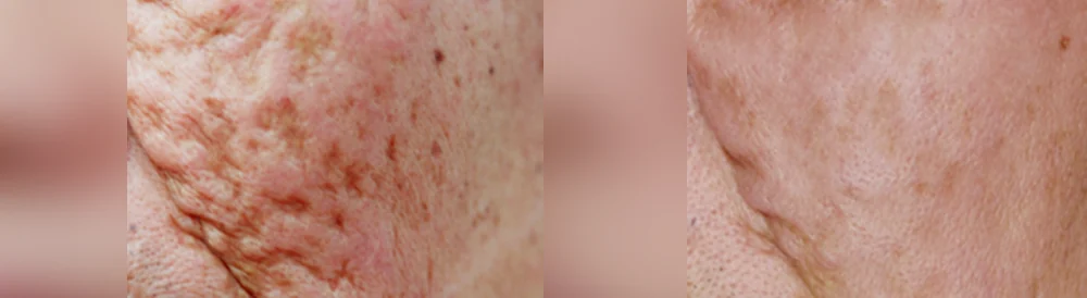 수두·마마·구순열 흉터 시술 전후 사진 15 · 보니따의원