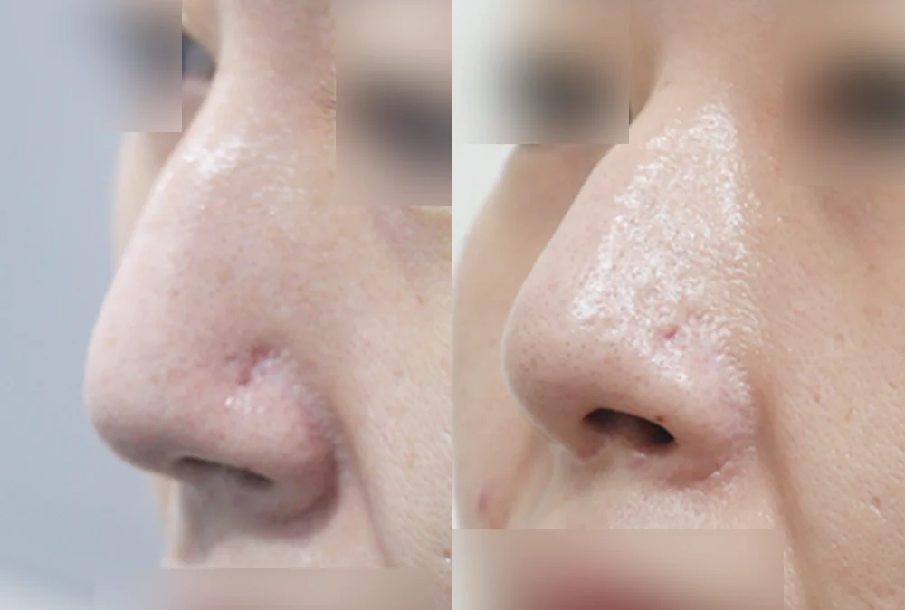 코 보형물 제거 시술 전후 사진 2 · 보니따의원