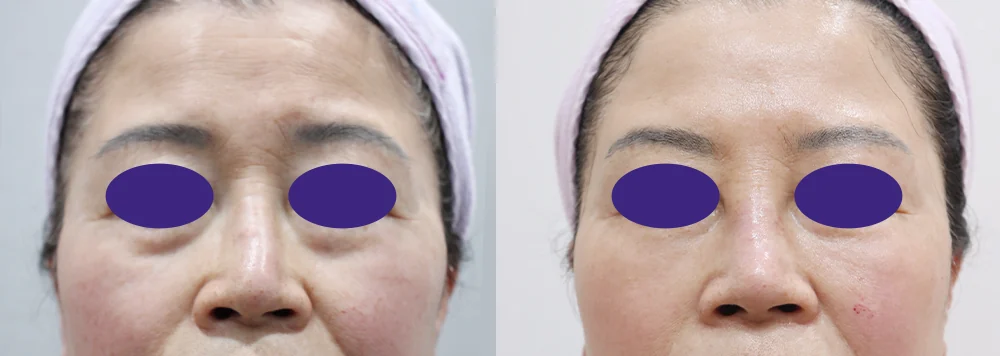 코 보형물 제거 시술 전후 사진 5 · 보니따의원