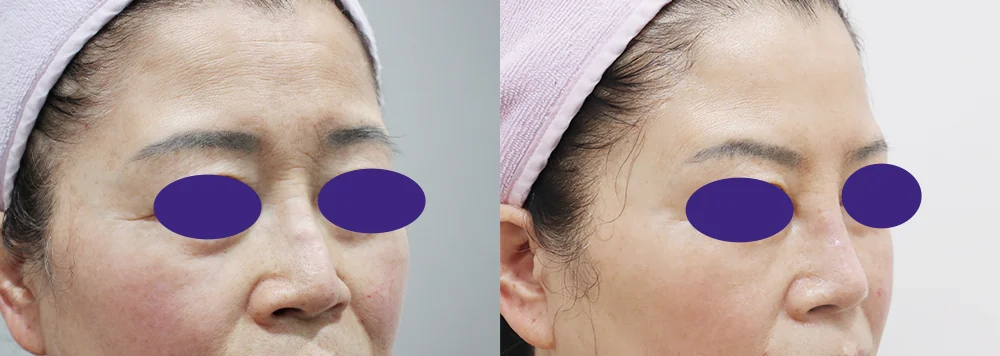 코 보형물 제거 시술 전후 사진 6 · 보니따의원
