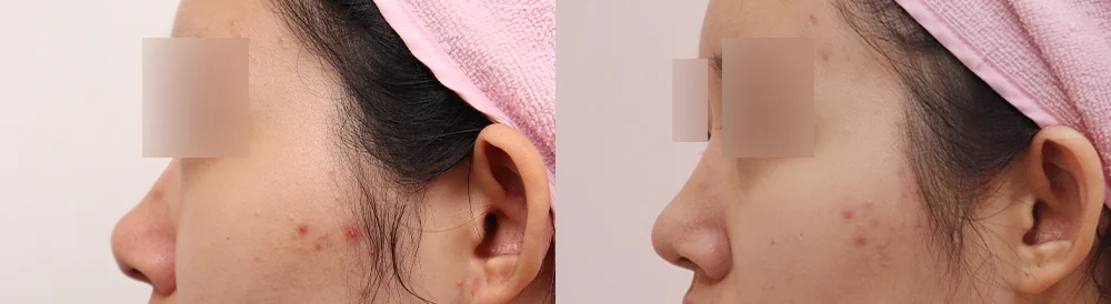 휜코 성형 시술 전후 사진 6 · 보니따의원