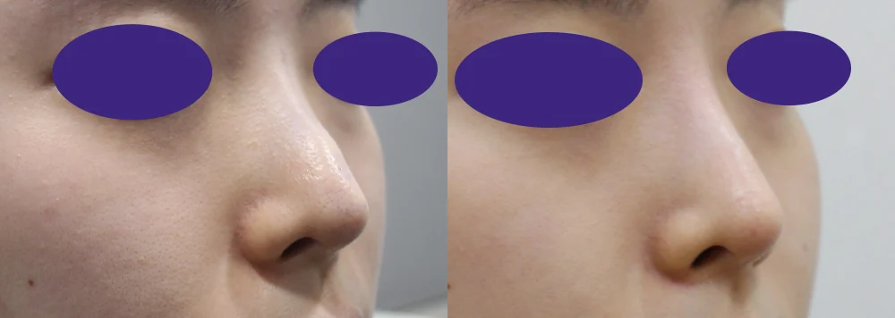 화살코 성형 시술 전후 사진 5 · 보니따의원