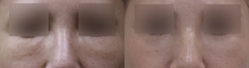 눈·미간·코 성형 부작용 재건 시술 전후 사진 14 · 보니따의원