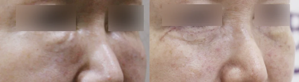 눈·미간·코 성형 부작용 재건 시술 전후 사진 15 · 보니따의원