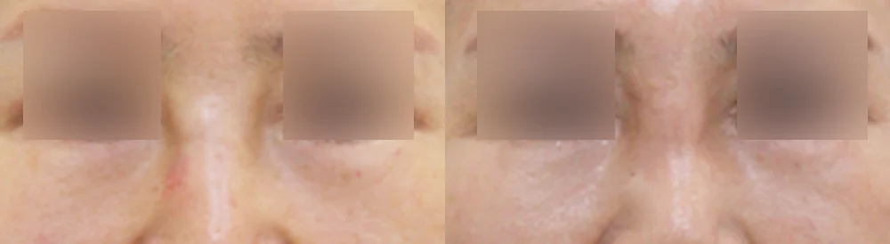 눈·미간·코 성형 부작용 재건 시술 전후 사진 16 · 보니따의원