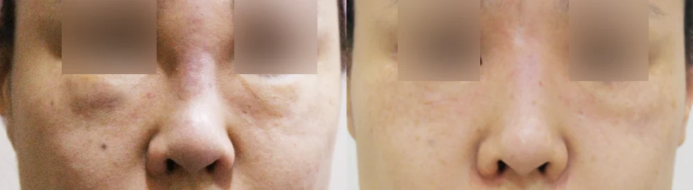 눈·미간·코 성형 부작용 재건 시술 전후 사진 17 · 보니따의원
