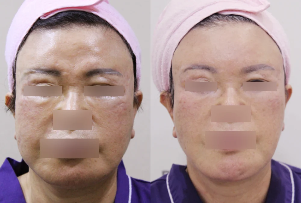 눈·미간·코 성형 부작용 재건 시술 전후 사진 1 · 보니따의원
