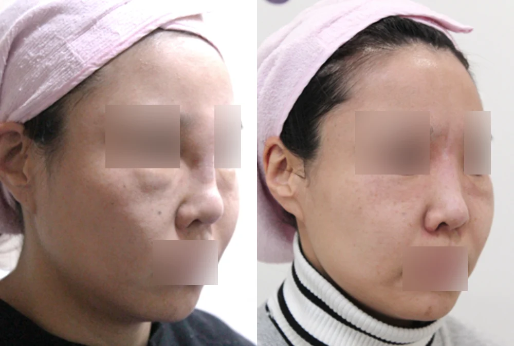 눈·미간·코 성형 부작용 재건 시술 전후 사진 4 · 보니따의원