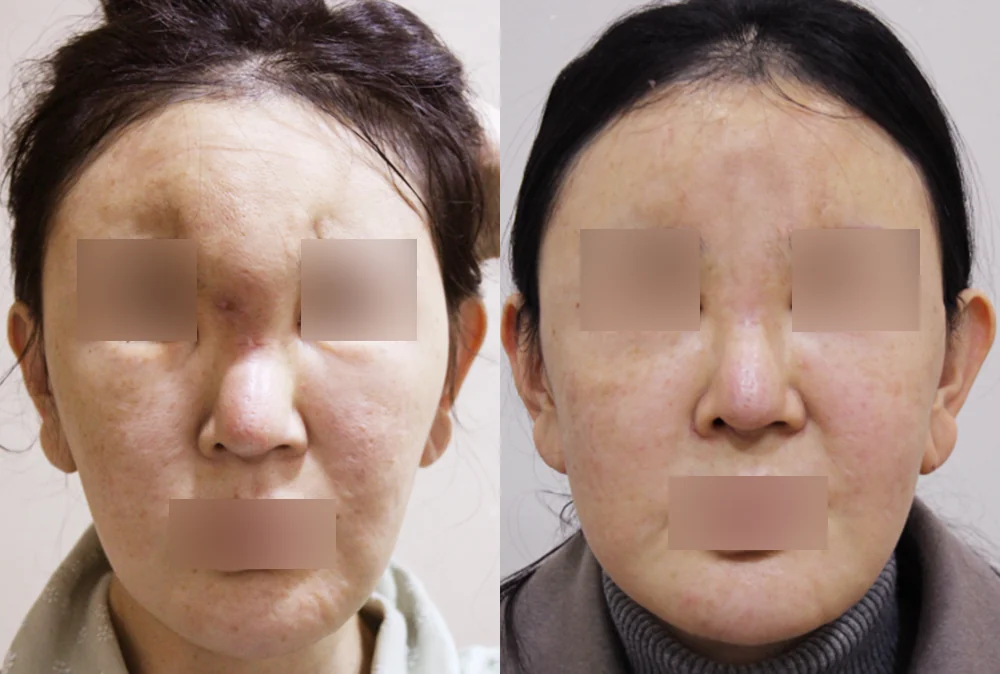 눈·미간·코 성형 부작용 재건 시술 전후 사진 5 · 보니따의원