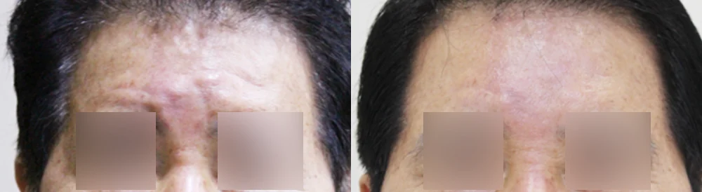 눈·미간·코 성형 부작용 재건 시술 전후 사진 20 · 보니따의원