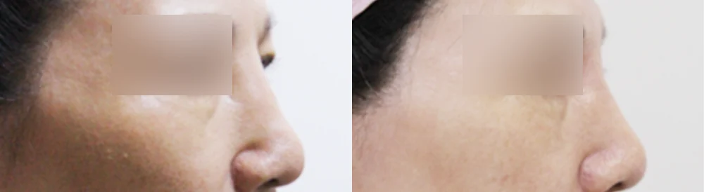눈·미간·코 성형 부작용 재건 시술 전후 사진 21 · 보니따의원