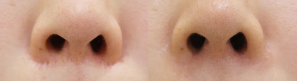 눈·미간·코 성형 부작용 재건 시술 전후 사진 24 · 보니따의원