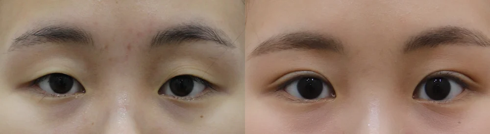눈 성형 시술 전후 사진 6 · 보니따의원