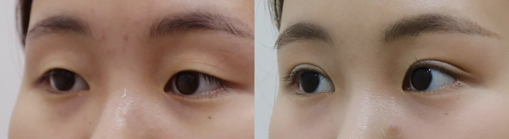 눈 성형 시술 전후 사진 7 · 보니따의원