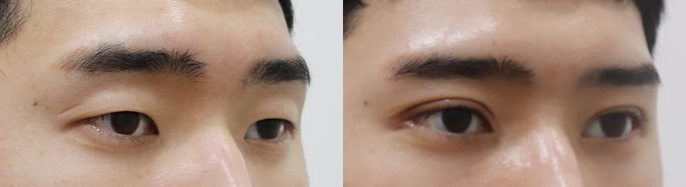 눈 성형 시술 전후 사진 21 · 보니따의원