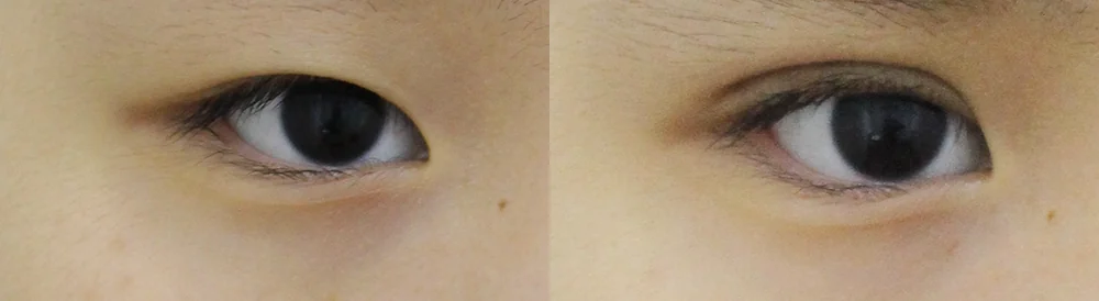 눈 성형 시술 전후 사진 24 · 보니따의원