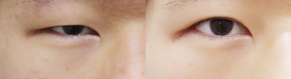 눈 성형 시술 전후 사진 26 · 보니따의원