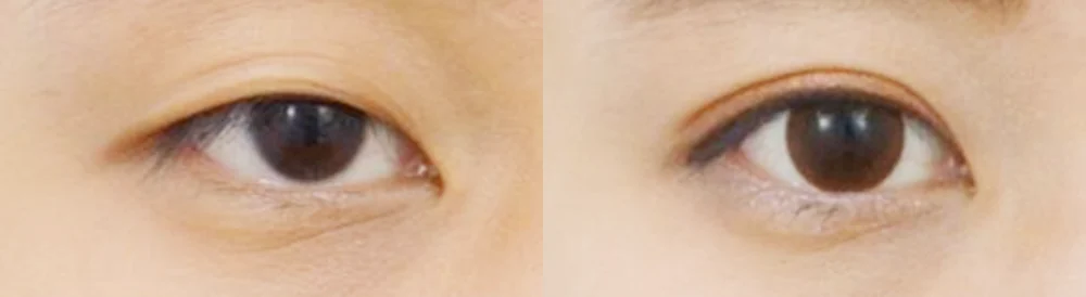 눈 성형 시술 전후 사진 32 · 보니따의원