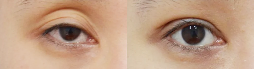 눈 성형 시술 전후 사진 33 · 보니따의원