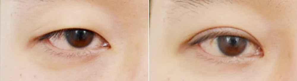 눈 성형 시술 전후 사진 36 · 보니따의원