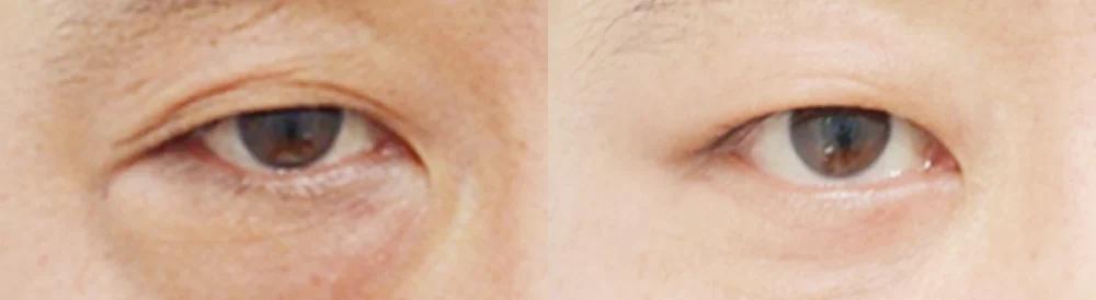 눈 성형 시술 전후 사진 38 · 보니따의원