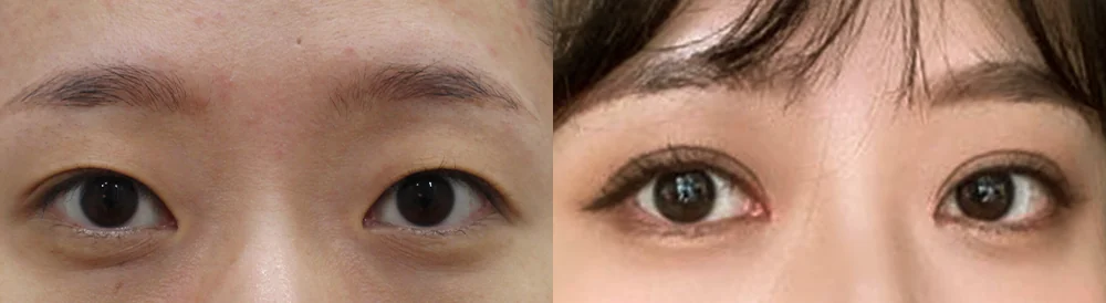 눈 성형 시술 전후 사진 40 · 보니따의원