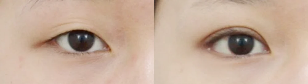 눈 성형 시술 전후 사진 42 · 보니따의원