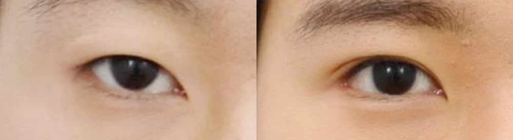 눈 성형 시술 전후 사진 43 · 보니따의원
