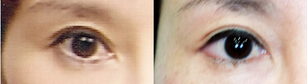 눈 성형 시술 전후 사진 48 · 보니따의원