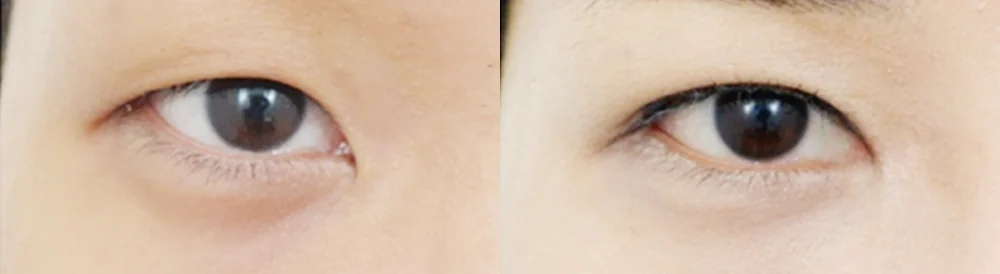 눈 성형 시술 전후 사진 52 · 보니따의원