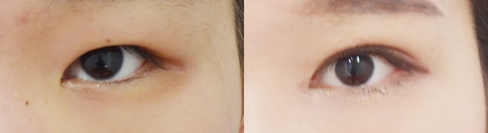 눈 성형 시술 전후 사진 53 · 보니따의원