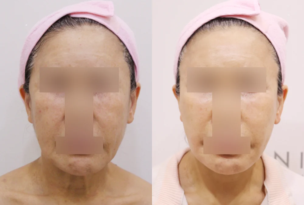 안면거상술 시술 전후 사진 3 · 보니따의원