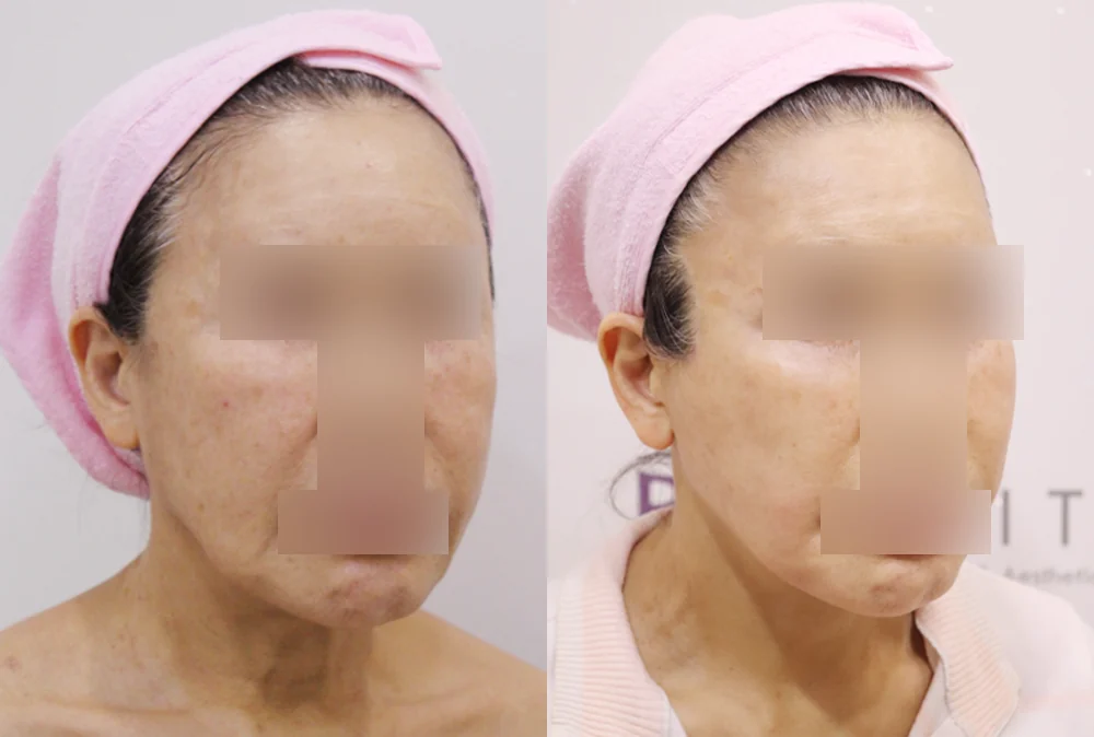 안면거상술 시술 전후 사진 1 · 보니따의원