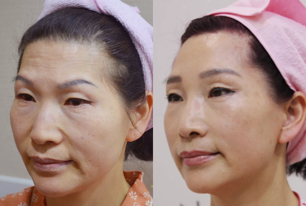 안면거상술 시술 전후 사진 4 · 보니따의원