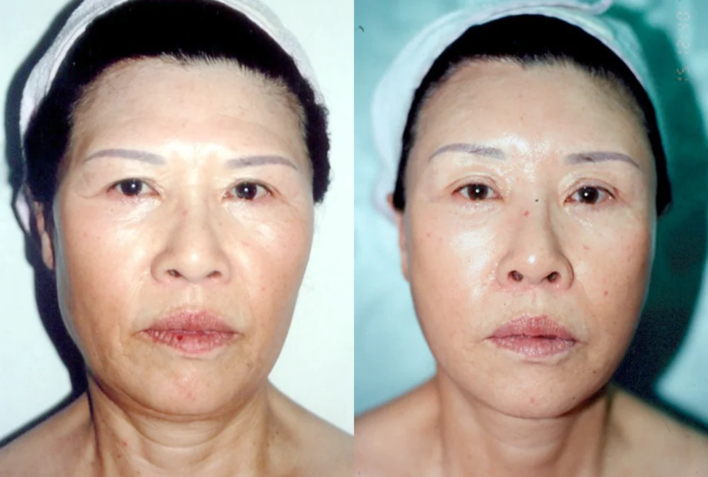 안면거상술 시술 전후 사진 5 · 보니따의원