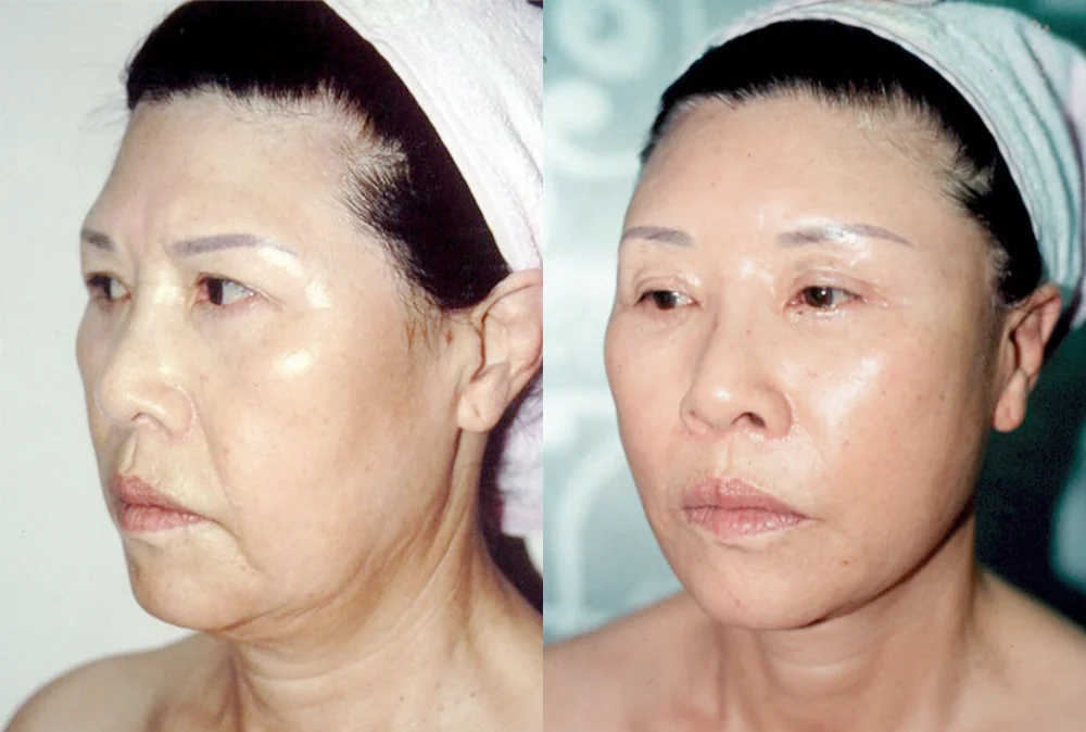 안면거상술 시술 전후 사진 7 · 보니따의원