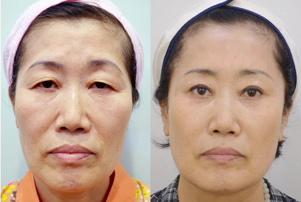 안면거상술 시술 전후 사진 8 · 보니따의원