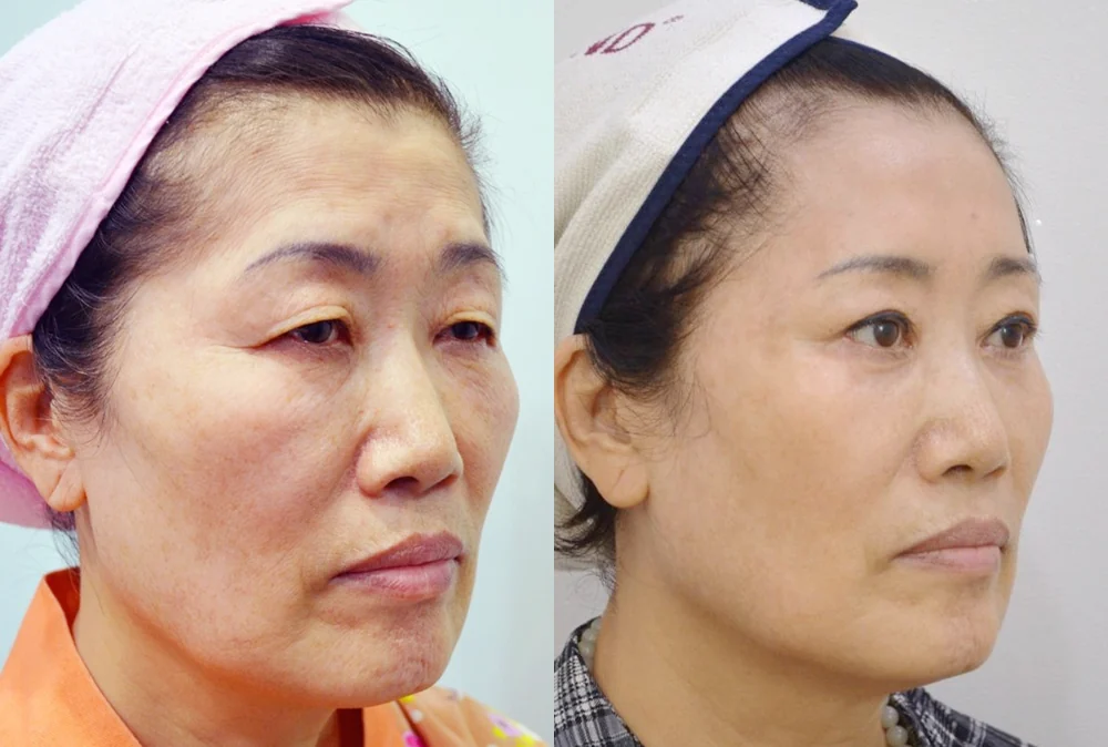 안면거상술 시술 전후 사진 9 · 보니따의원