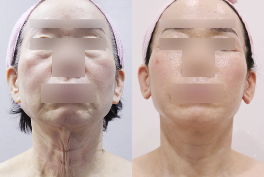 안면거상술 시술 전후 사진 11 · 보니따의원