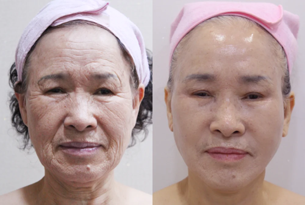 안면거상술 시술 전후 사진 12 · 보니따의원