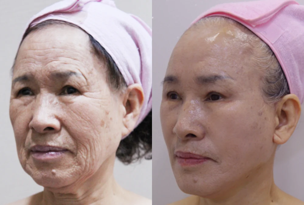 안면거상술 시술 전후 사진 13 · 보니따의원