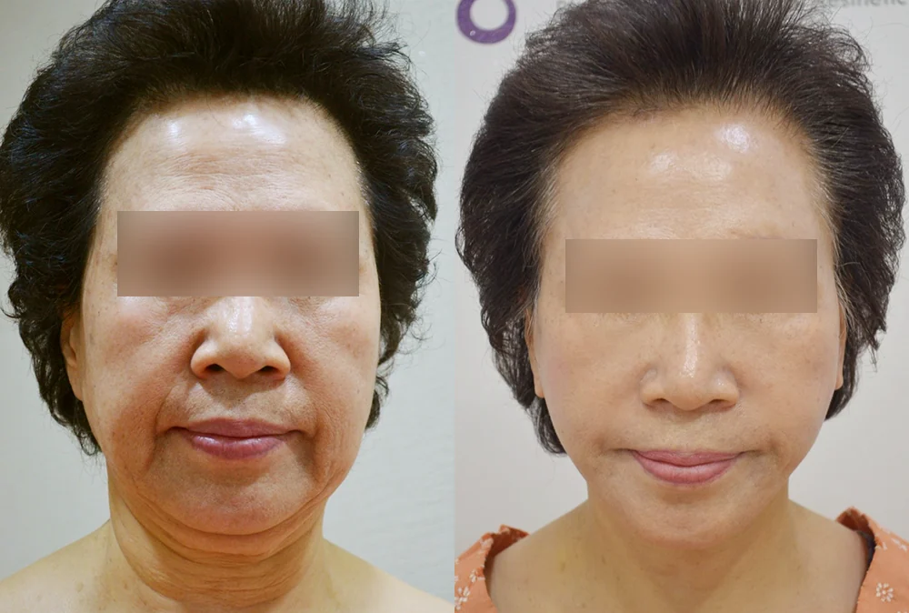 안면거상술 시술 전후 사진 14 · 보니따의원