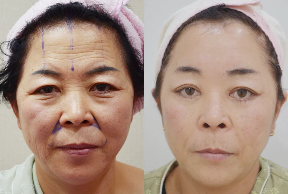 안면거상술 시술 전후 사진 16 · 보니따의원