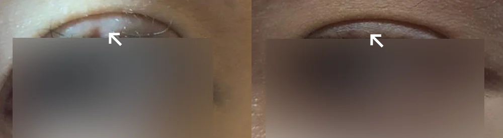 Face 패인·절개 흉터 시술 전후 사진 1 · 보니따의원