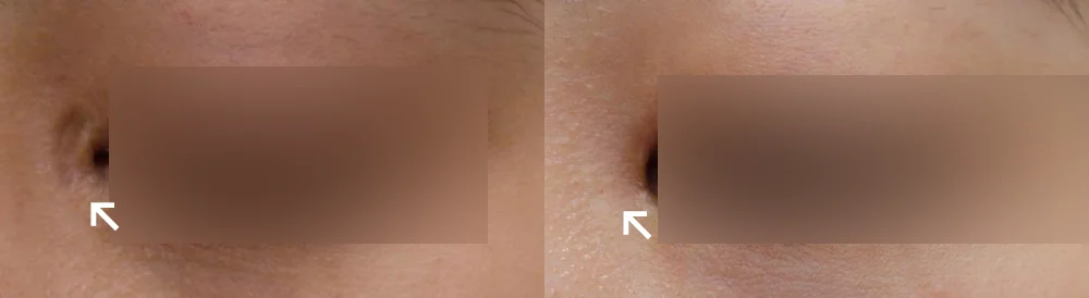 Face 패인·절개 흉터 시술 전후 사진 2 · 보니따의원