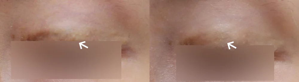 Face 패인·절개 흉터 시술 전후 사진 4 · 보니따의원