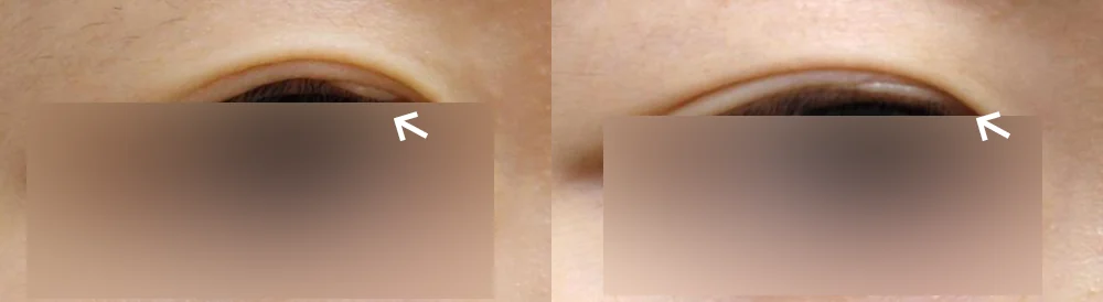 Face 패인·절개 흉터 시술 전후 사진 6 · 보니따의원