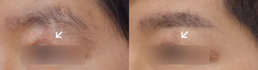 Face 패인·절개 흉터 시술 전후 사진 8 · 보니따의원